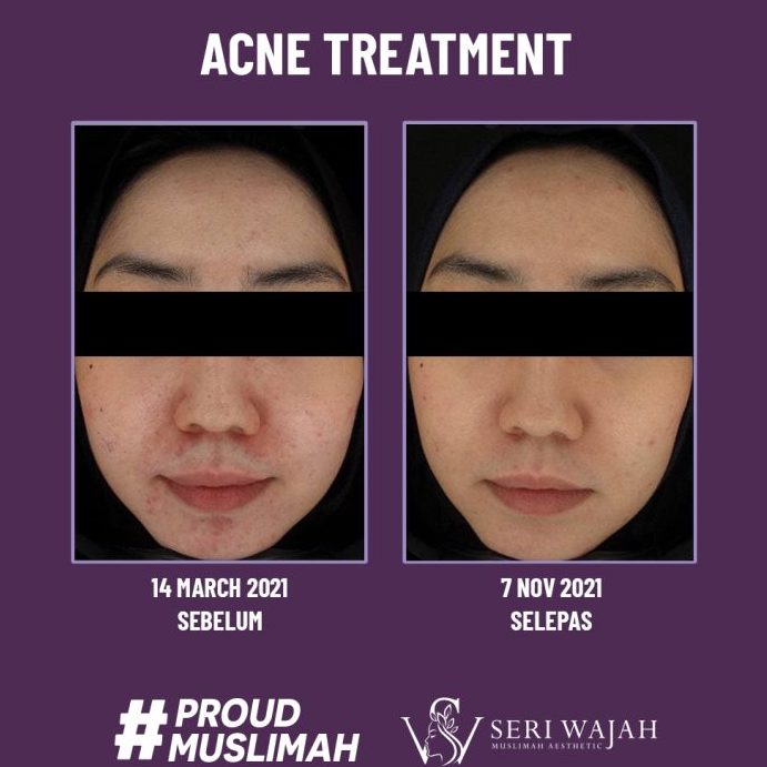 Seri Wajah Muslimah Facial Spa Batu Pahat 1 seri wajah muslimah facial spa batu pahat